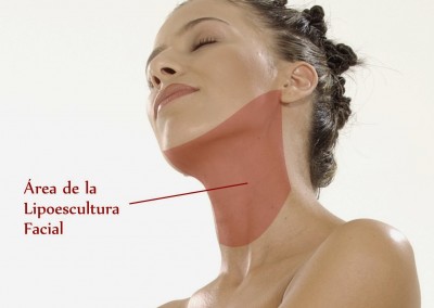 Lipoescultura de cara y cuello